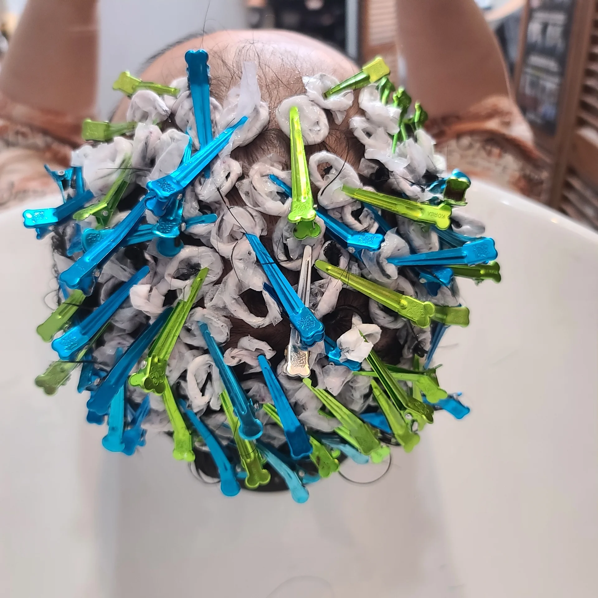 U자형 탈모 관련 사진