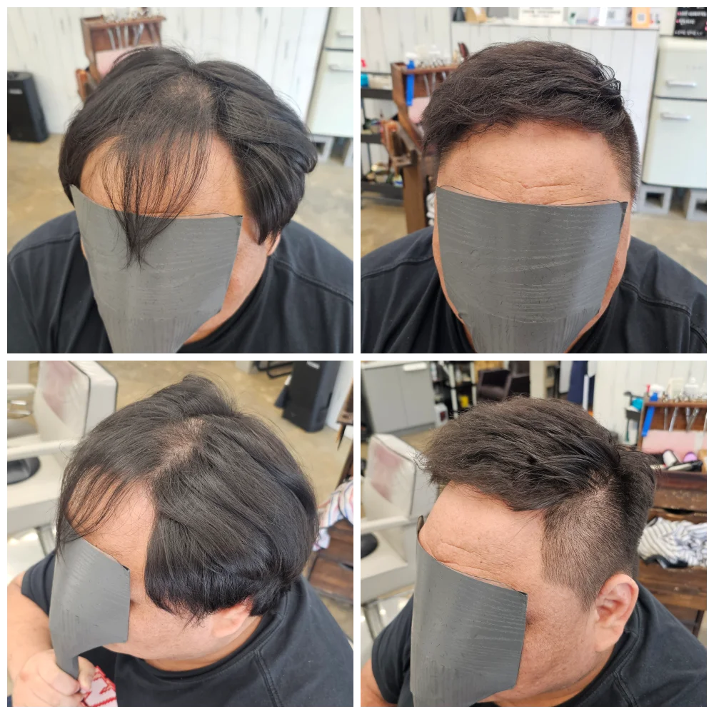 탈모 치트펌 시술 대표 사진