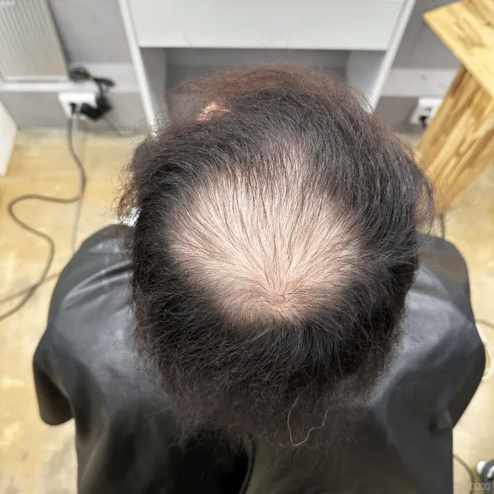 탈모 치트펌 시술 전 사진 2