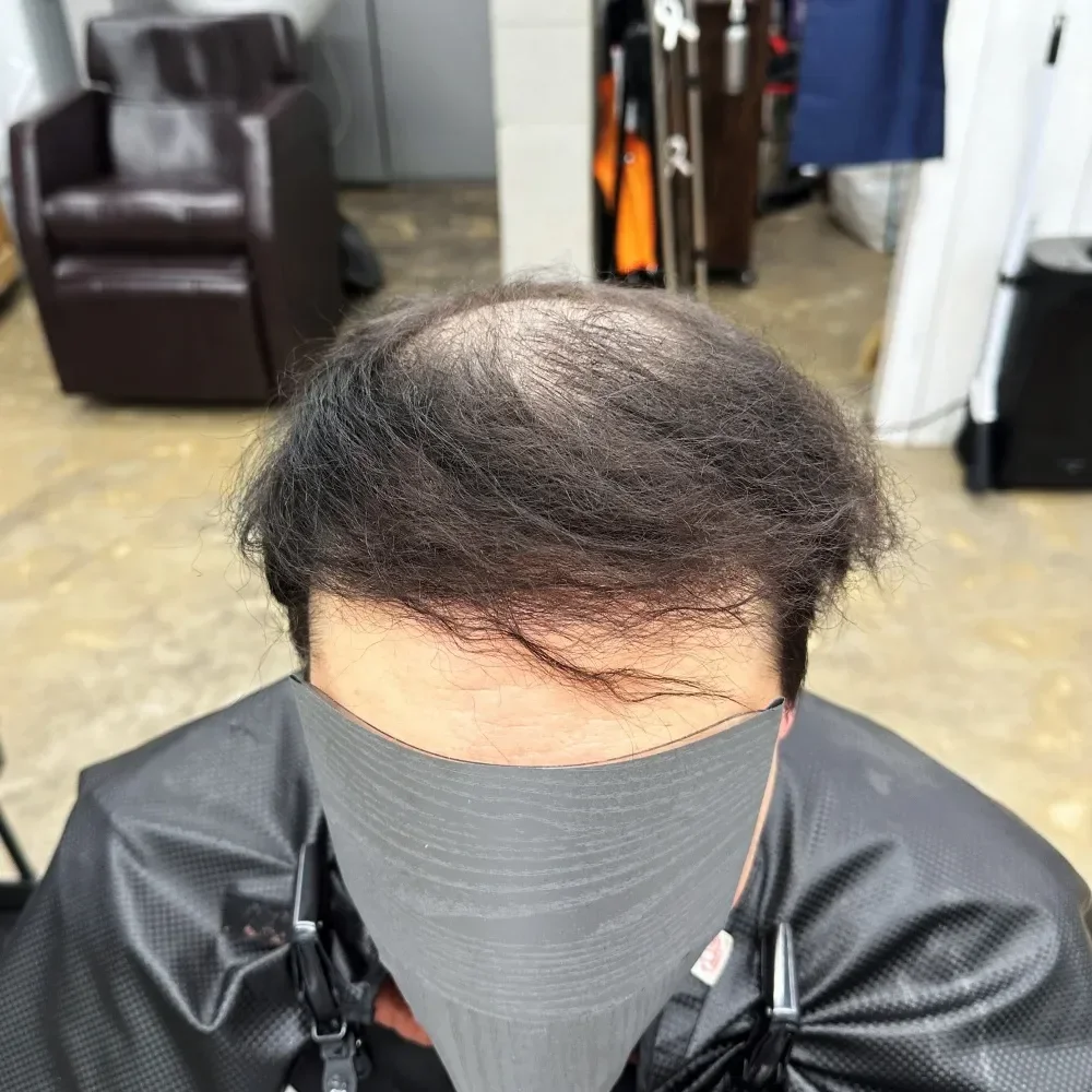 탈모 치트펌 시술 전 사진 3