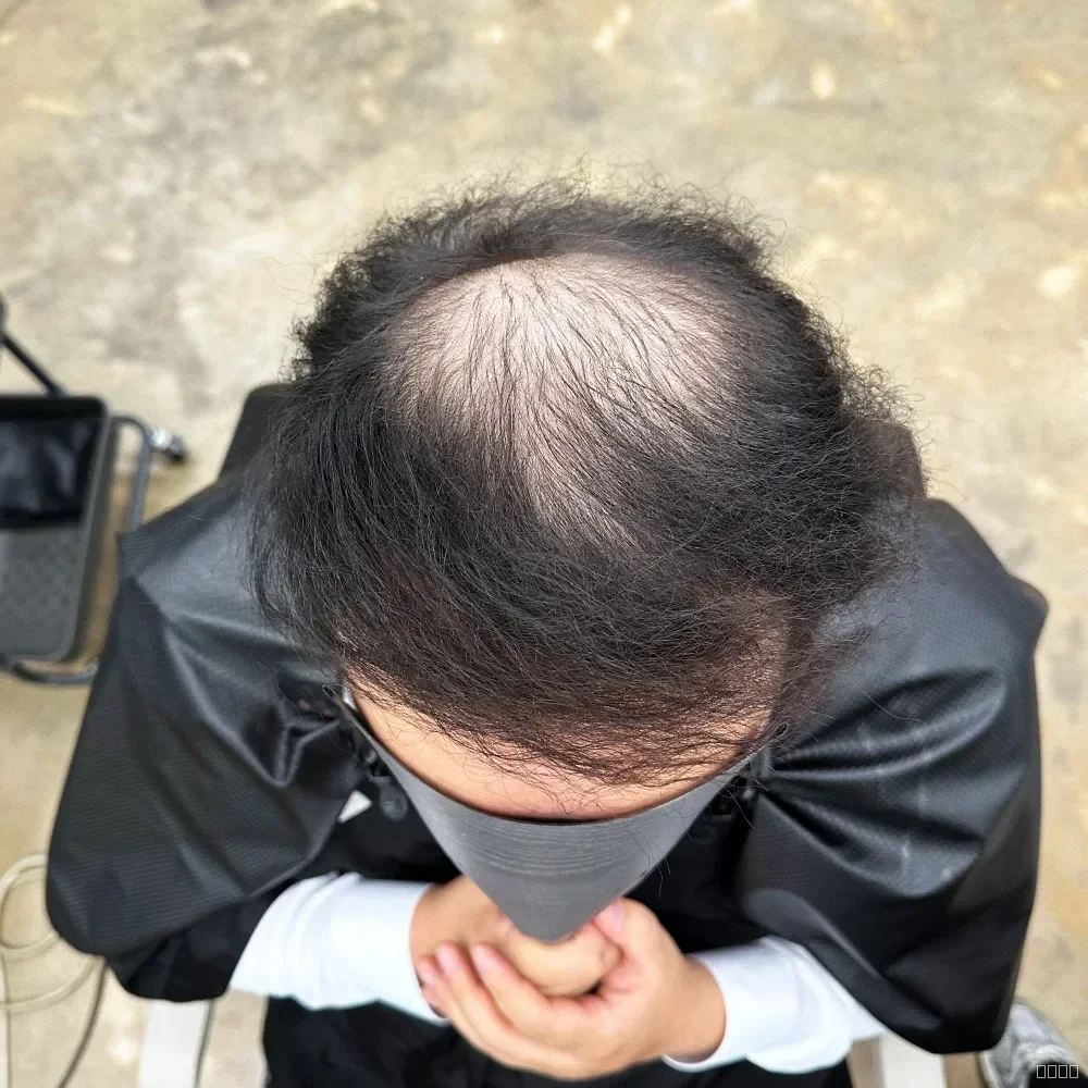 탈모 치트펌 시술 전 사진 4