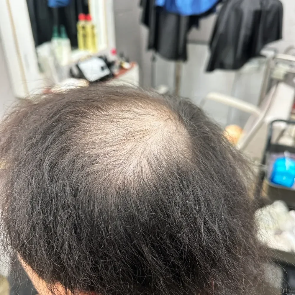 탈모 치트펌 시술 전 사진 5