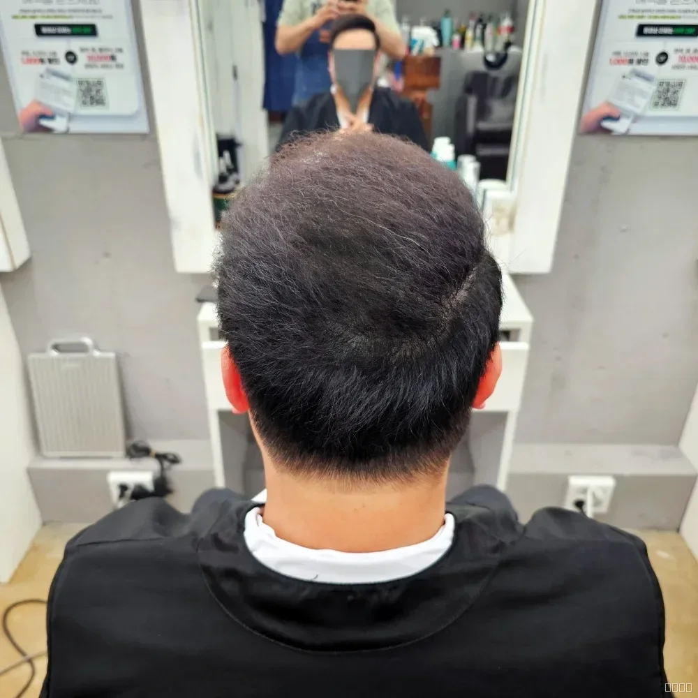 탈모 치트펌 시술 후 결과 사진 5