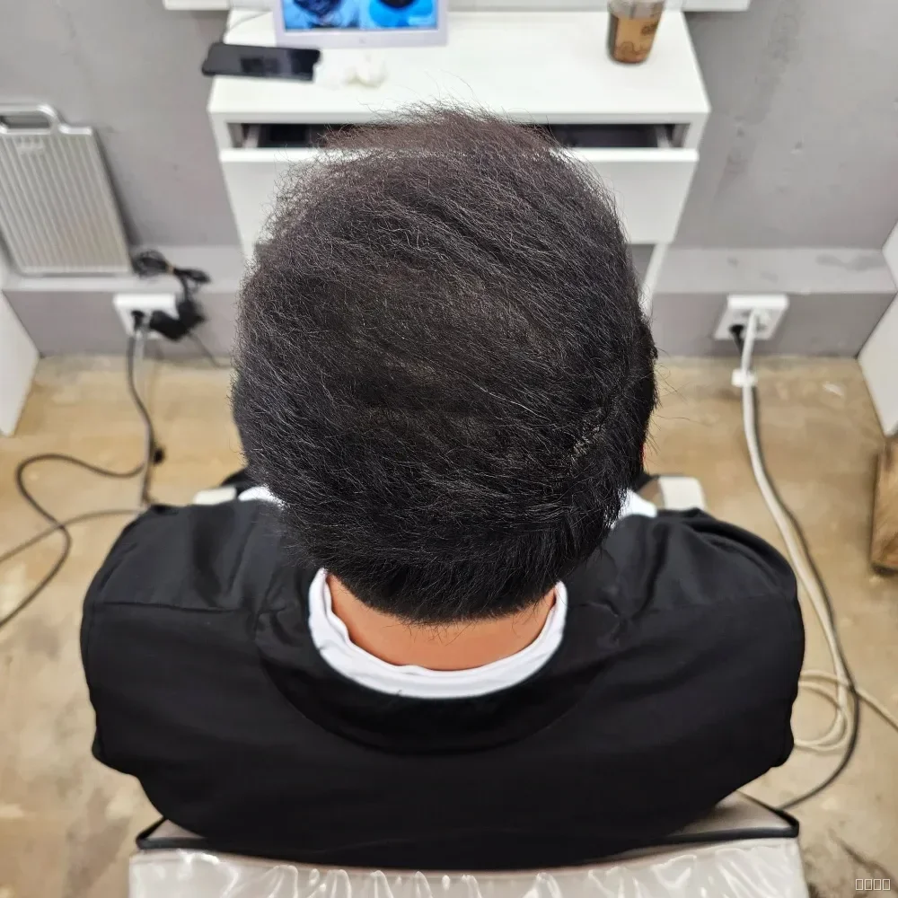 탈모 치트펌 시술 후 결과 사진 6