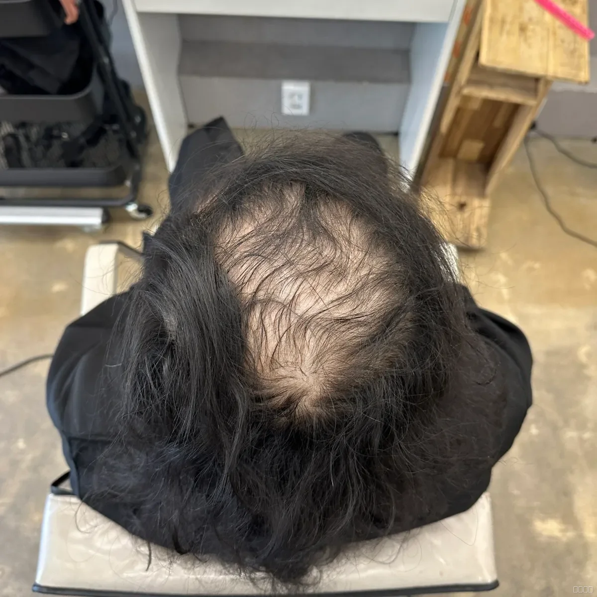 두피페인팅 (치트염색) 시술 전 사진 4