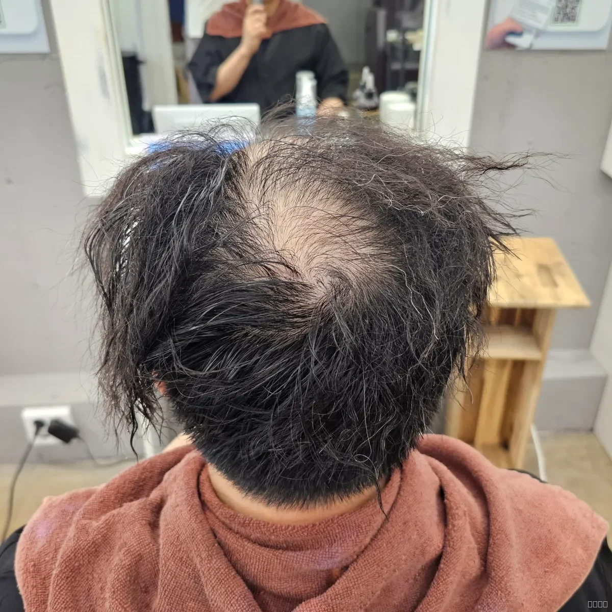 탈모 치트펌 시술 전 안양 탈모펌 모습