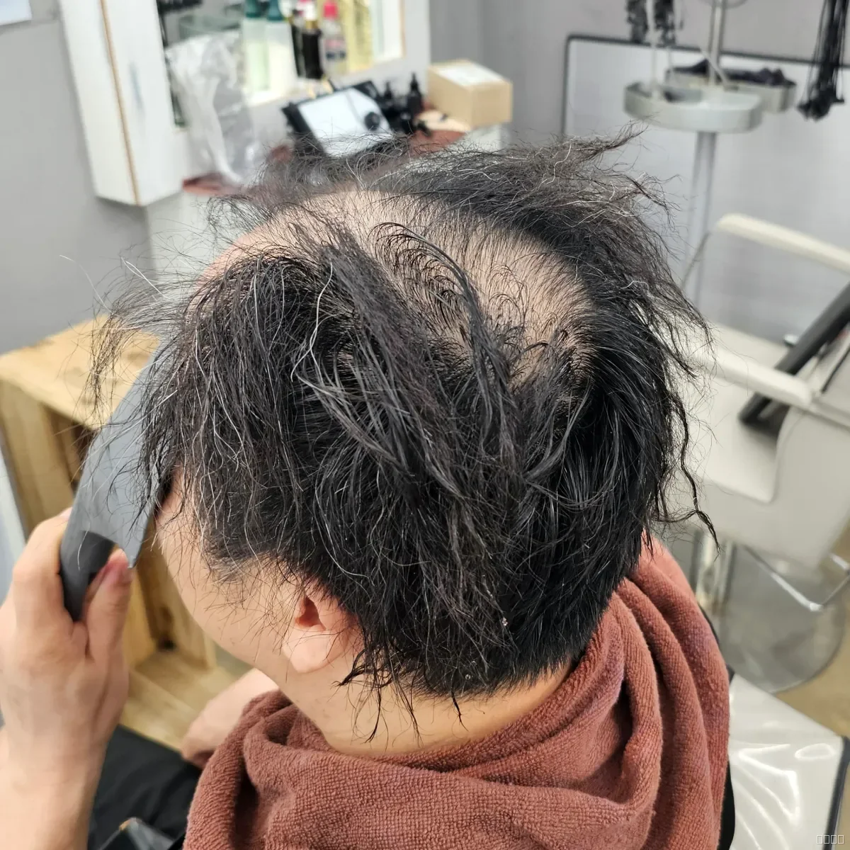 탈모 치트펌 시술 전 사진 2