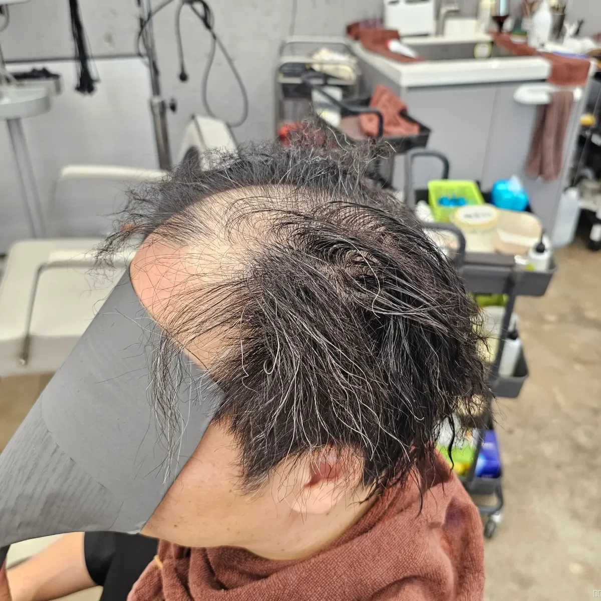 탈모 치트펌 시술 전 사진 3