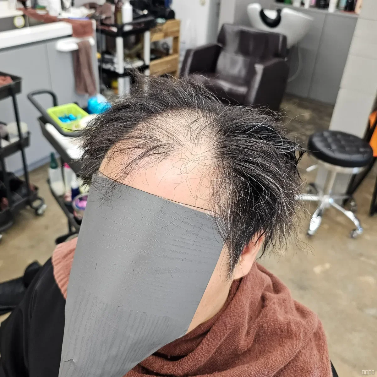 탈모 치트펌 시술 전 사진 4