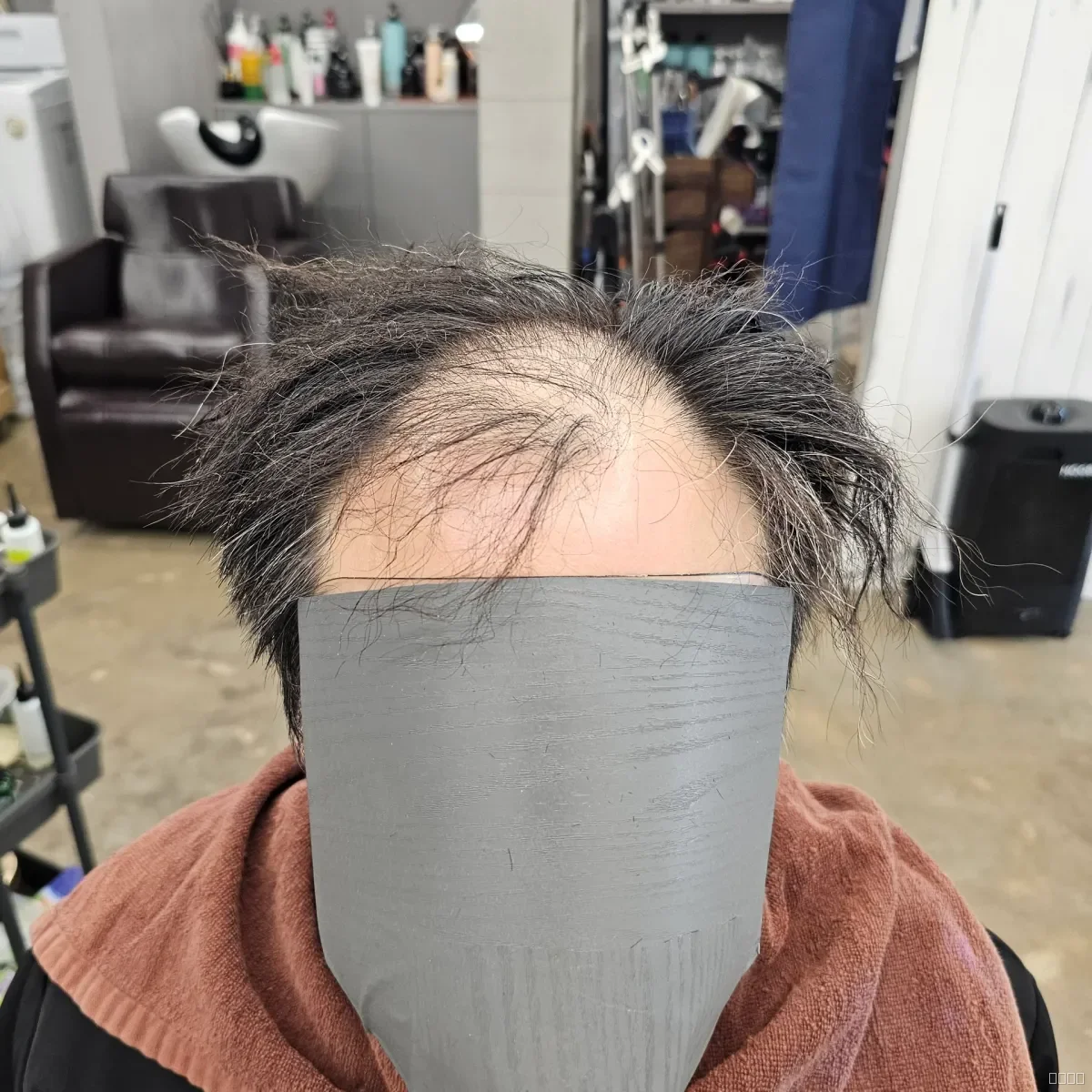 탈모 치트펌 시술 전 사진 5