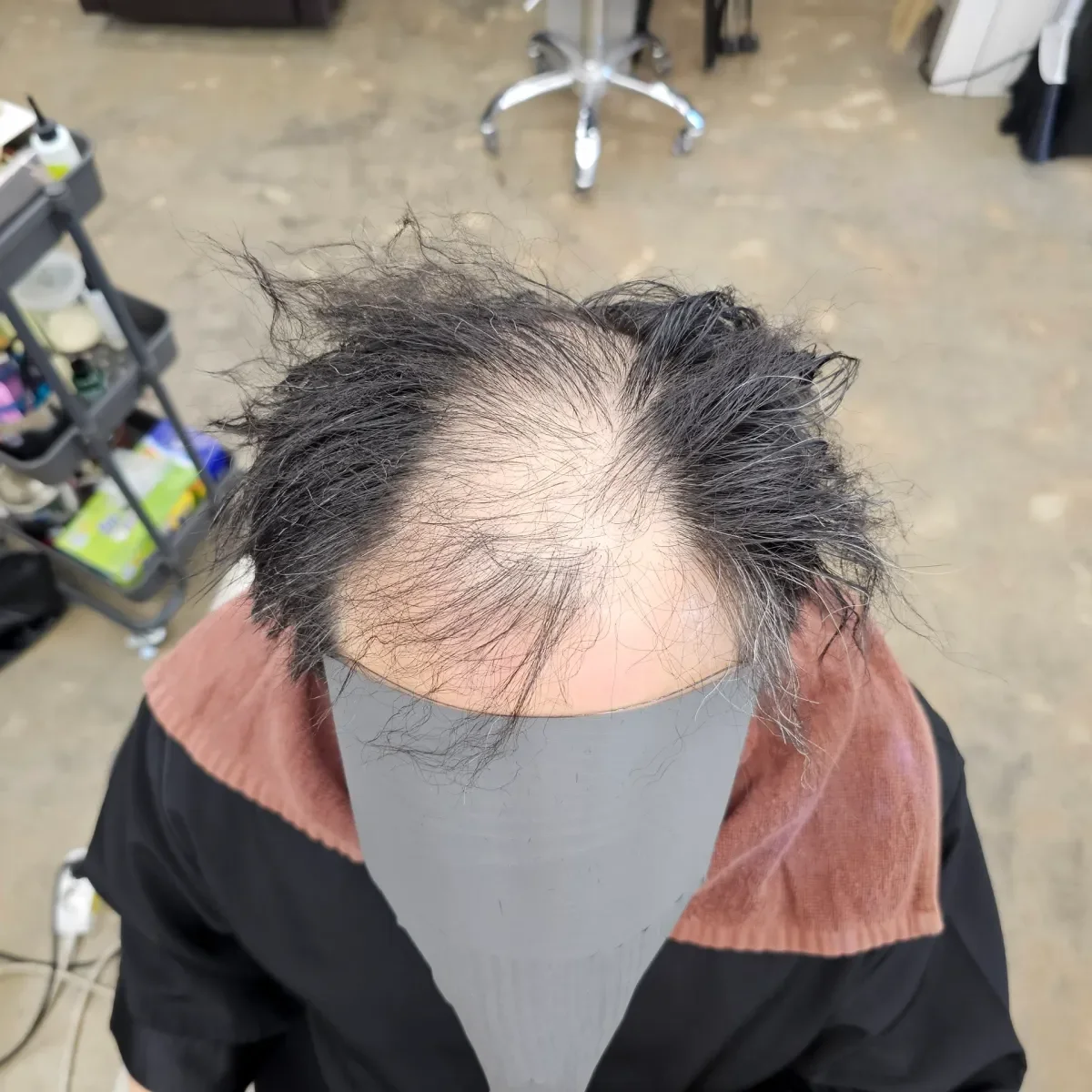 탈모 치트펌 시술 전 사진 6