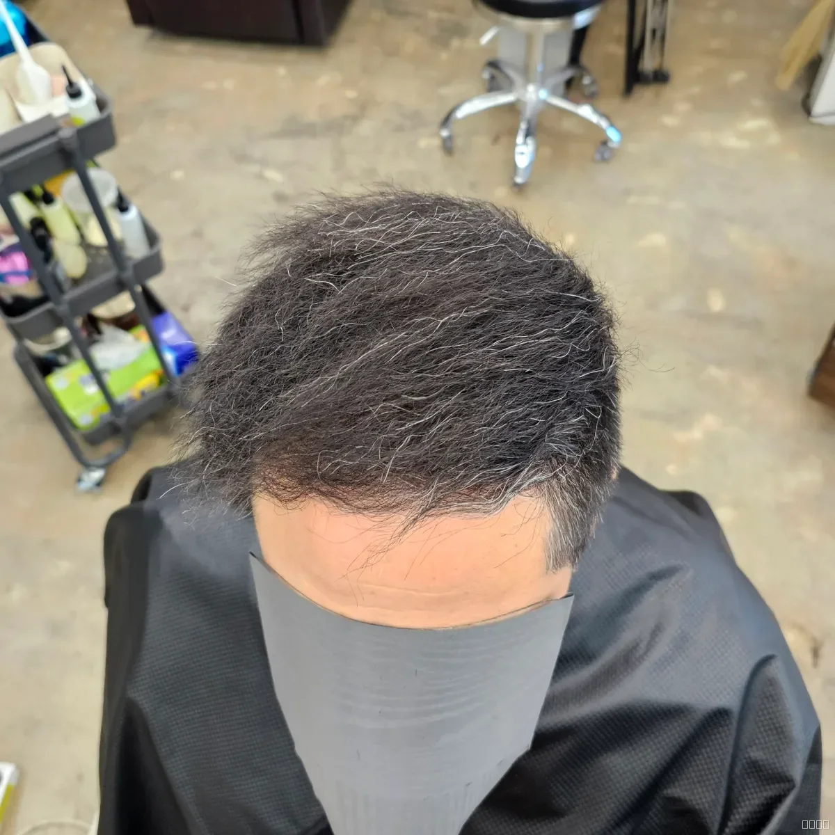 탈모 치트펌 시술 후 안양 탈모펌 결과