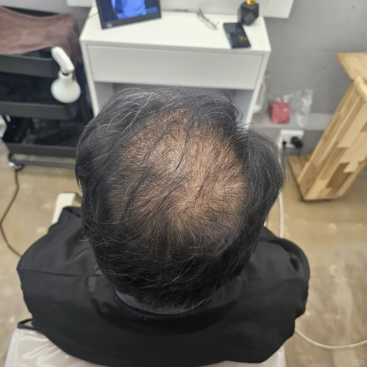 두피페인팅 (치트염색) 시술 전 사진 3