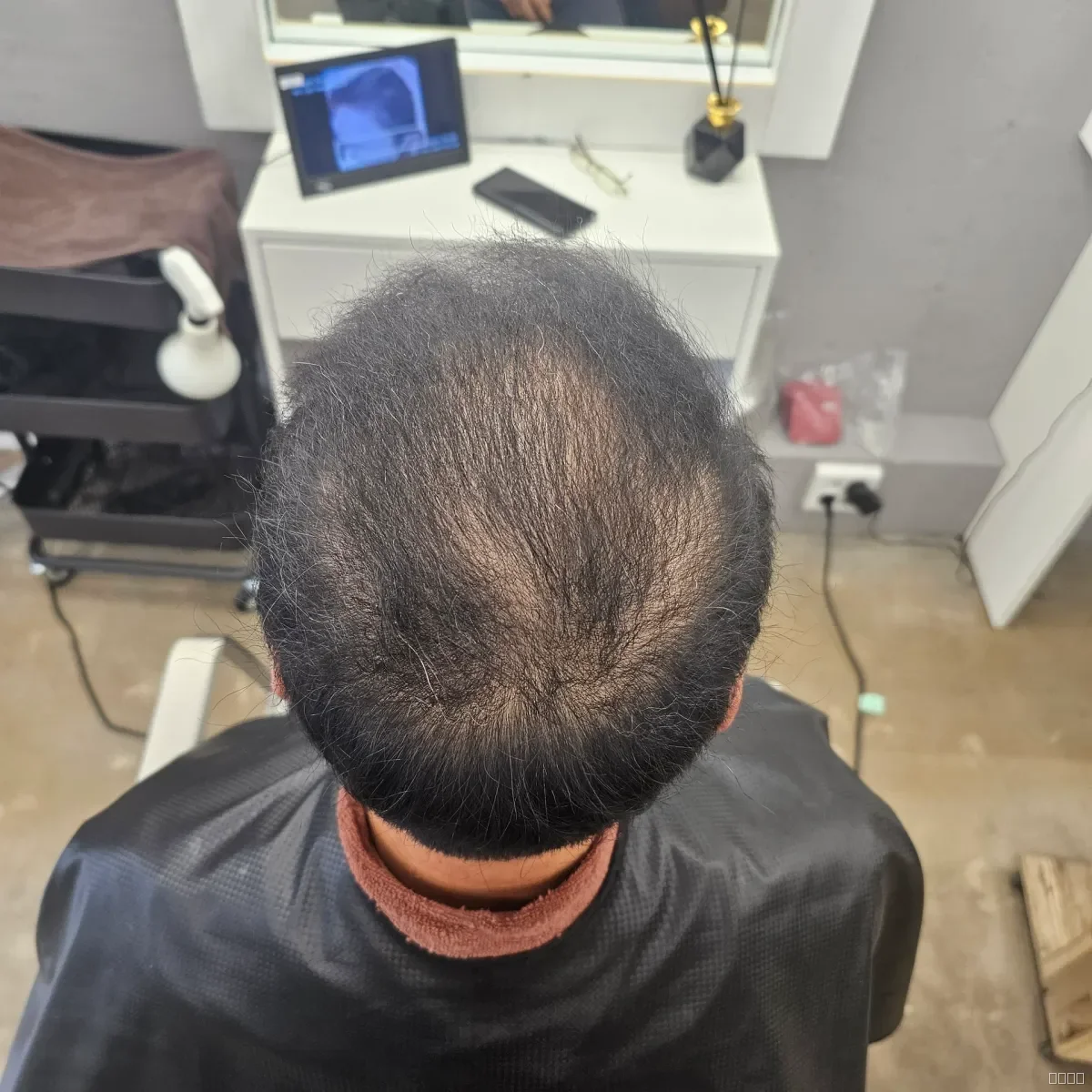 두피페인팅 (치트염색) 시술 전 사진 7