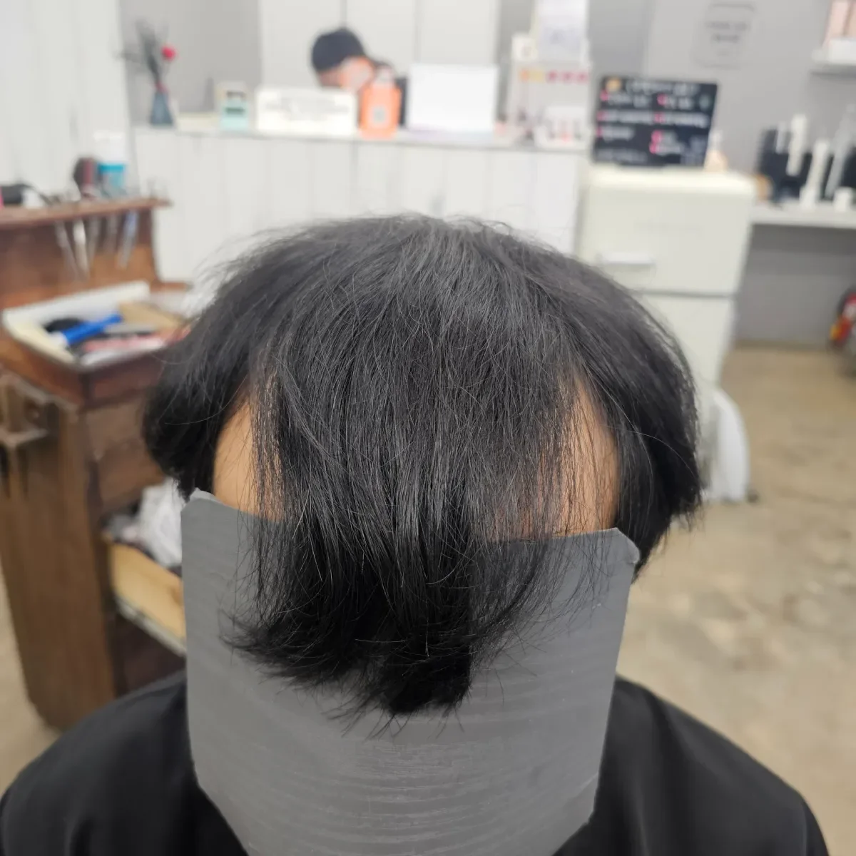 탈모 치트펌 시술 전 사진 2