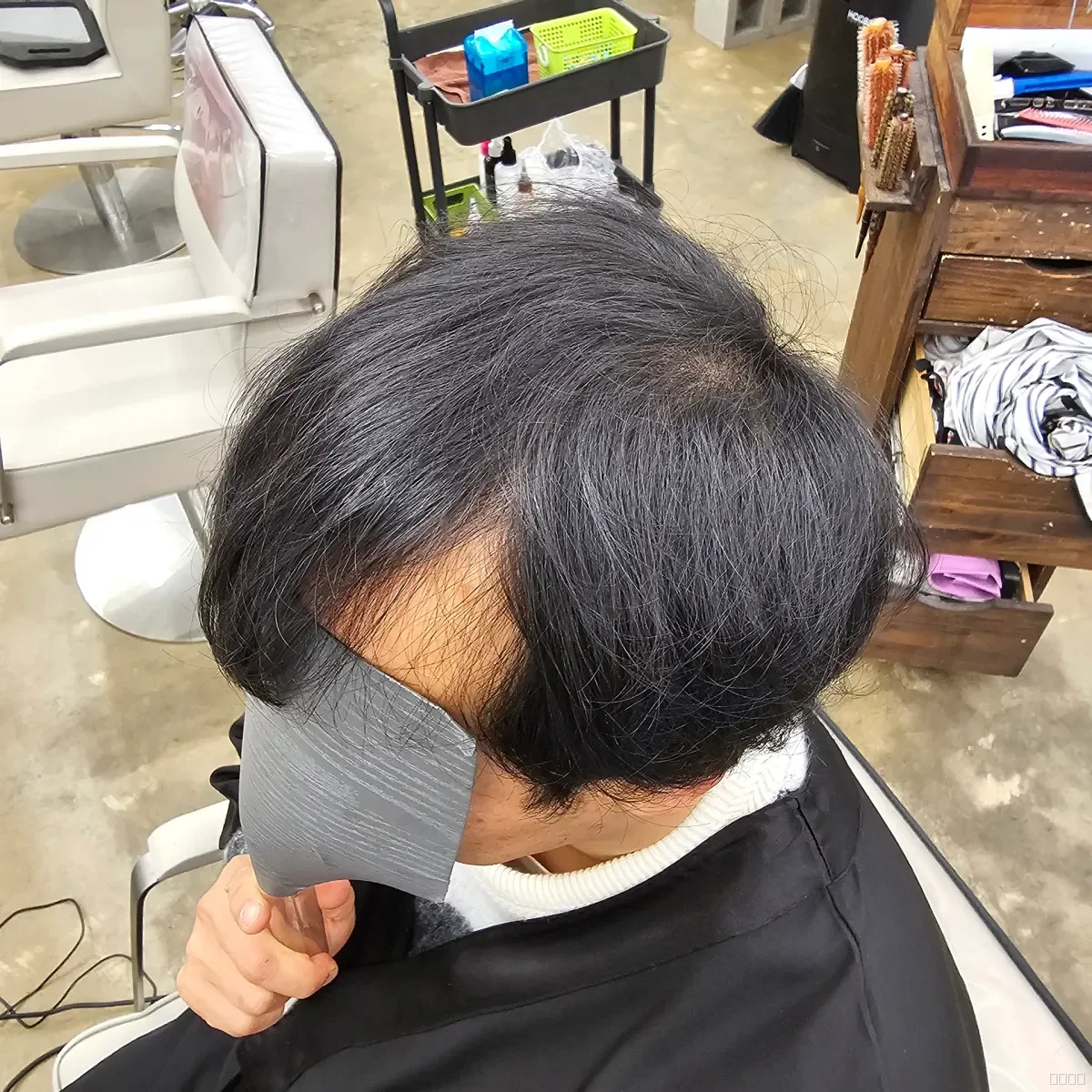 탈모 치트펌 시술 전 사진 3