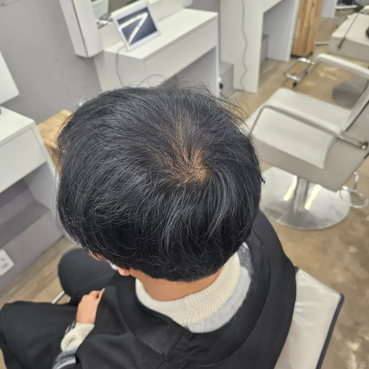 탈모 치트펌 시술 전 사진 4