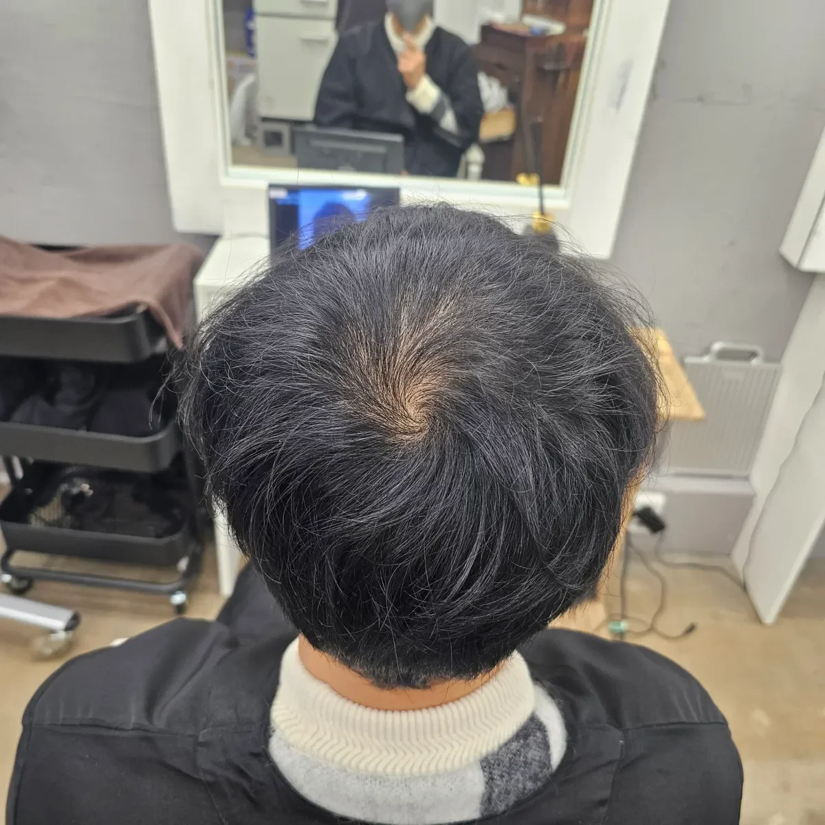 탈모 치트펌 시술 전 사진 5