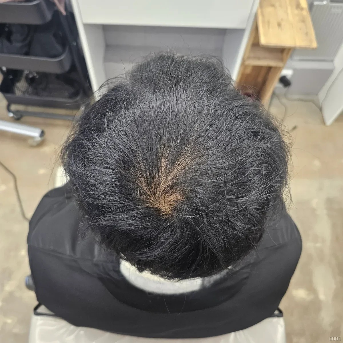 탈모 치트펌 시술 전 사진 6