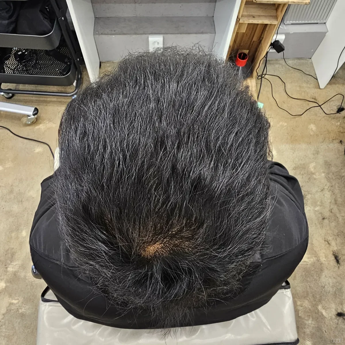 탈모 치트펌 시술 후 결과 사진 4