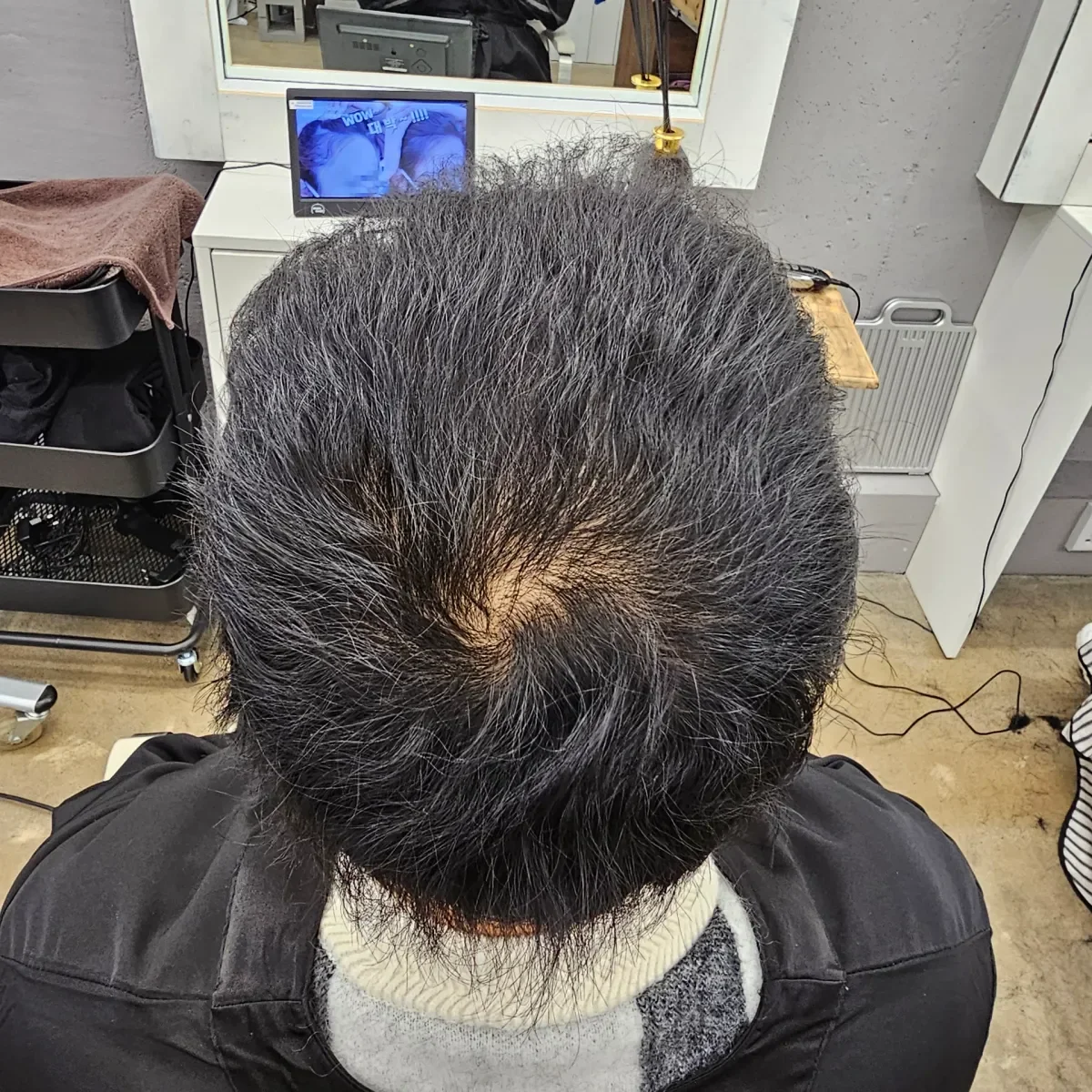 탈모 치트펌 시술 후 결과 사진 5