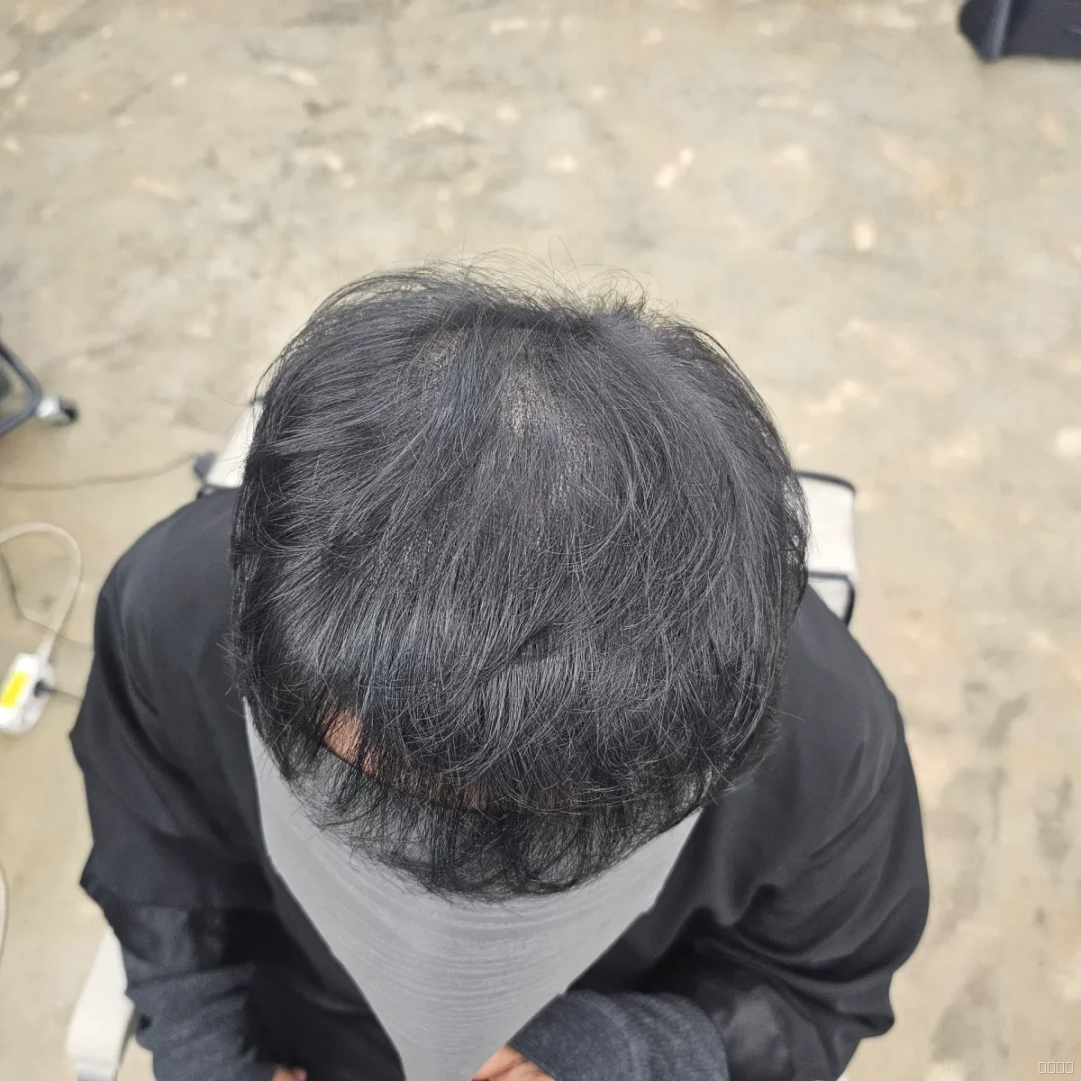 두피페인팅 (치트염색) 시술 후 두피페인팅 결과