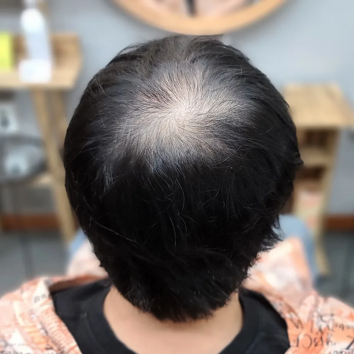 탈모 치트펌 시술 전 산본 탈모펌 모습