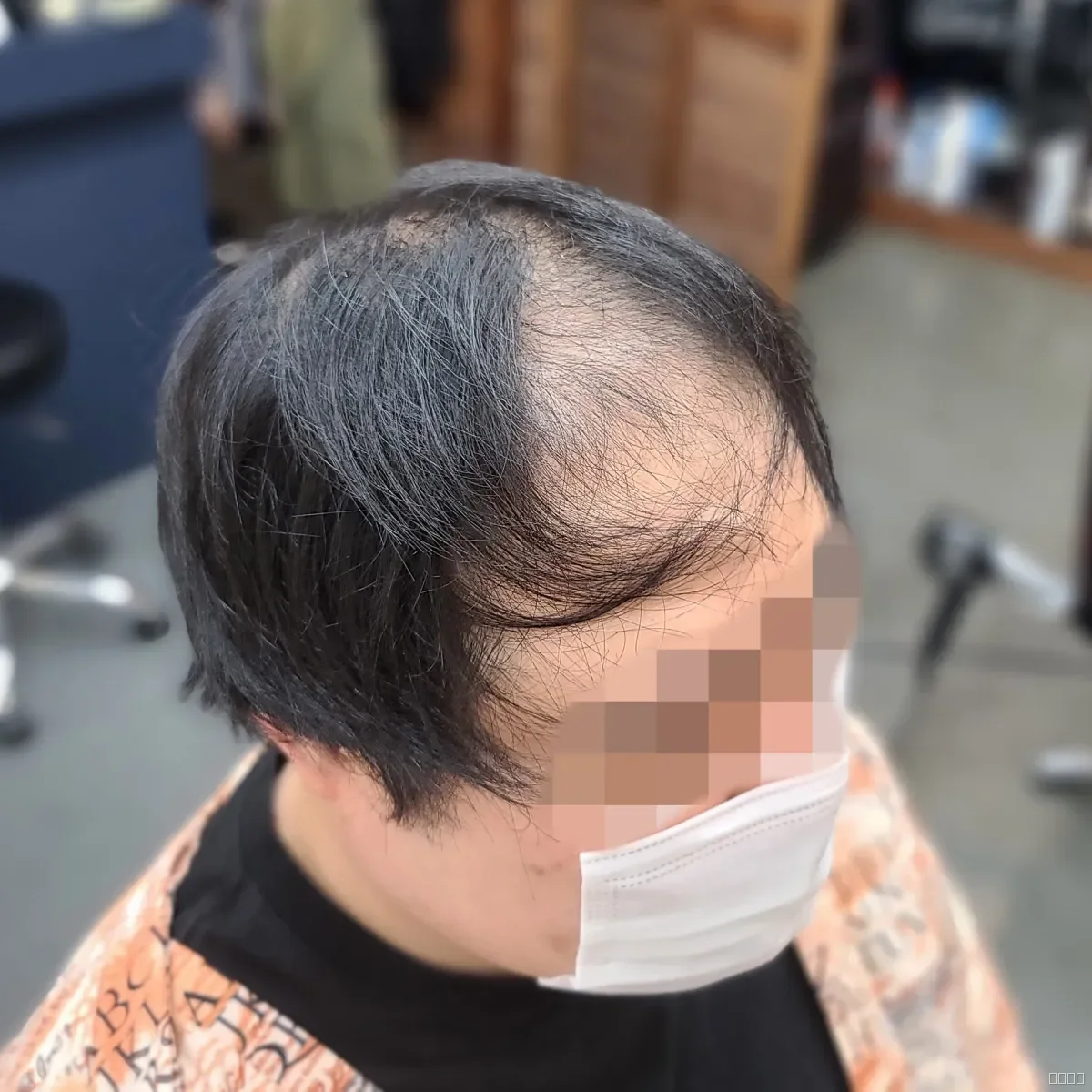 탈모 치트펌 시술 전 사진 2