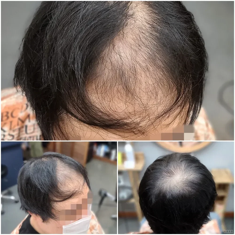 탈모 치트펌 시술 전 사진 4