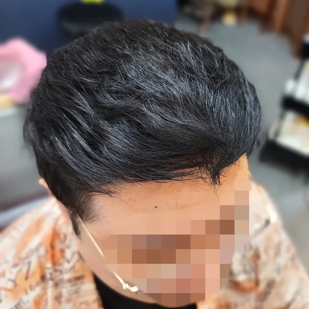 탈모 치트펌 시술 후 결과 사진 4