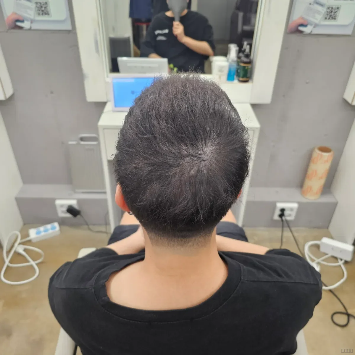 탈모 치트펌 시술 후 결과 사진 5