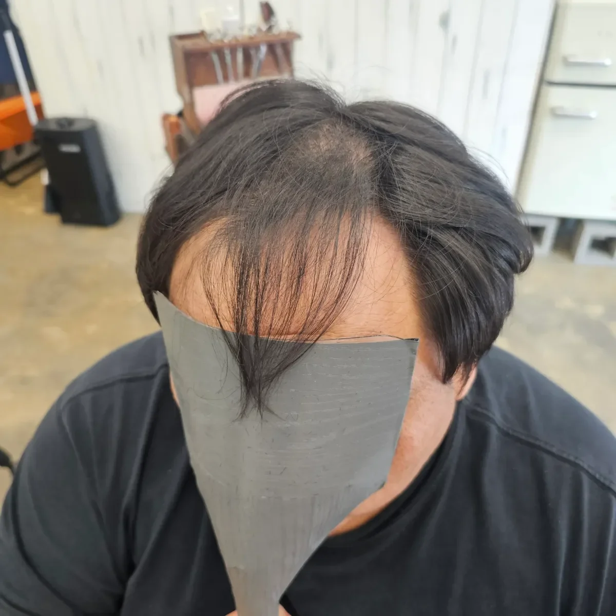 탈모 치트펌 시술 전 사진 1