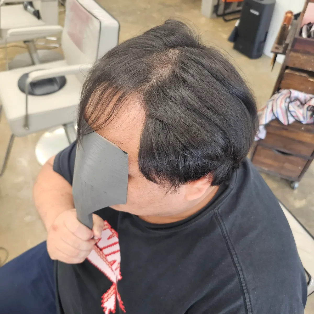 탈모 치트펌 시술 전 사진 2