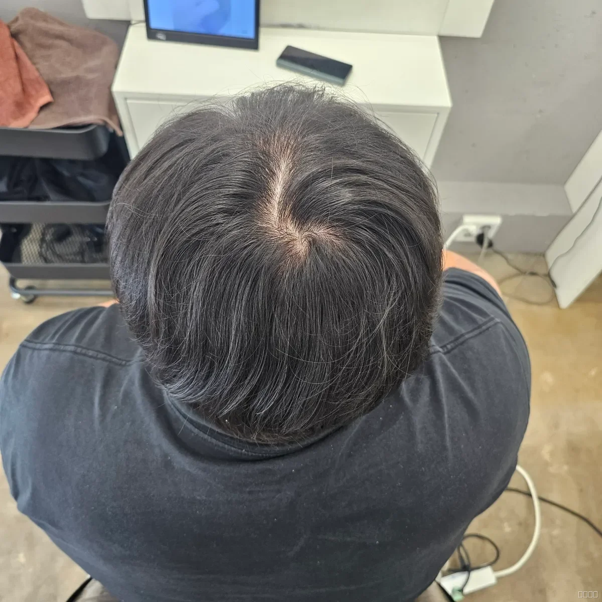탈모 치트펌 시술 전 사진 5
