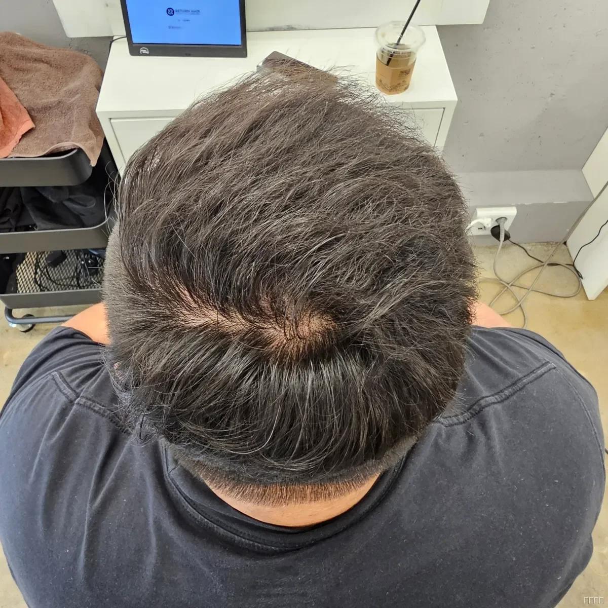 탈모 치트펌 시술 후 결과 사진 5