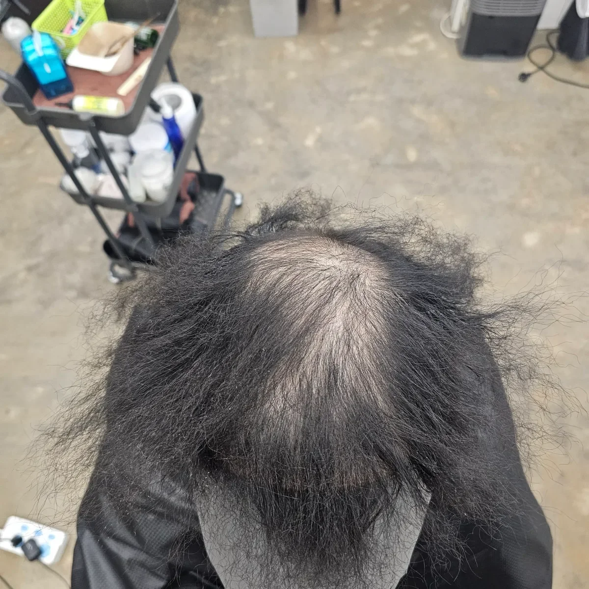 탈모 치트펌 파마 시술 전 사진