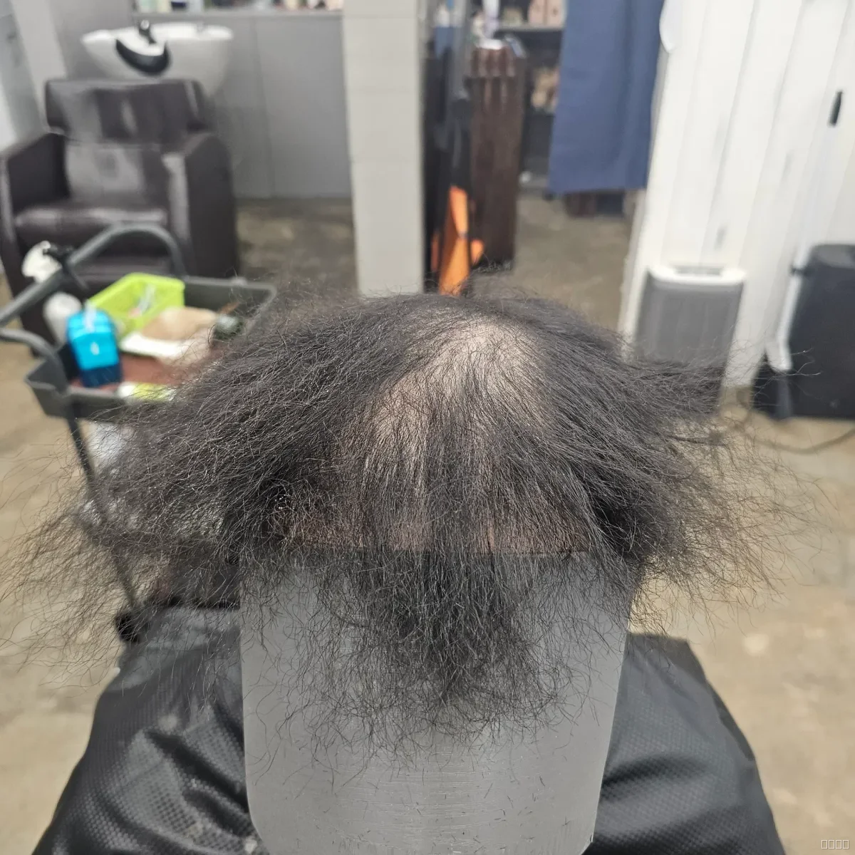 탈모 치트펌 파마 시술 전 사진 2