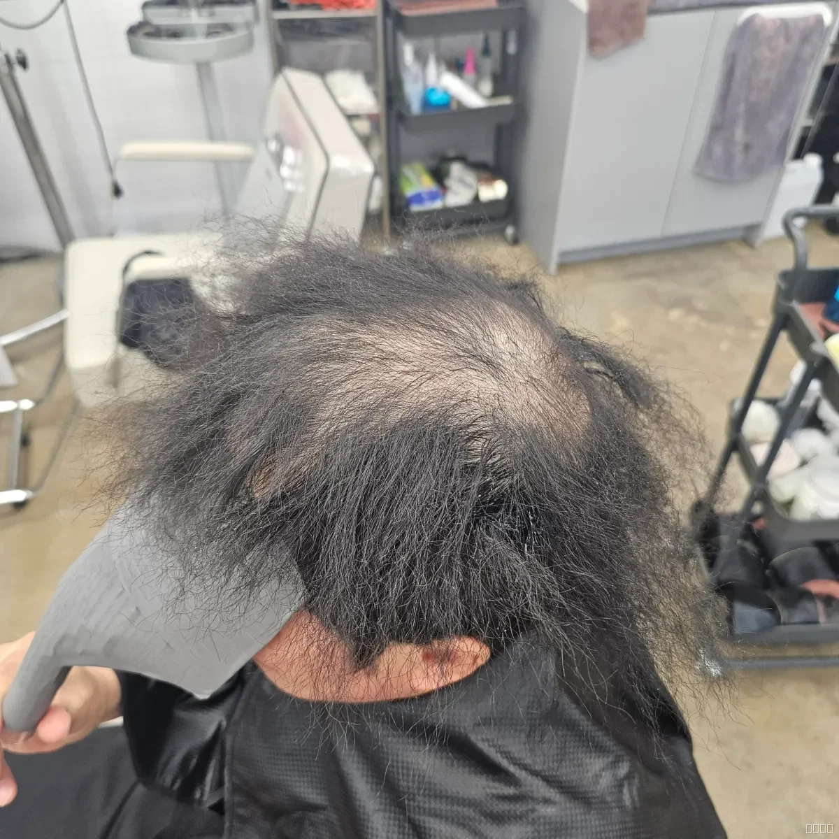 탈모 치트펌 파마 시술 전 사진 4