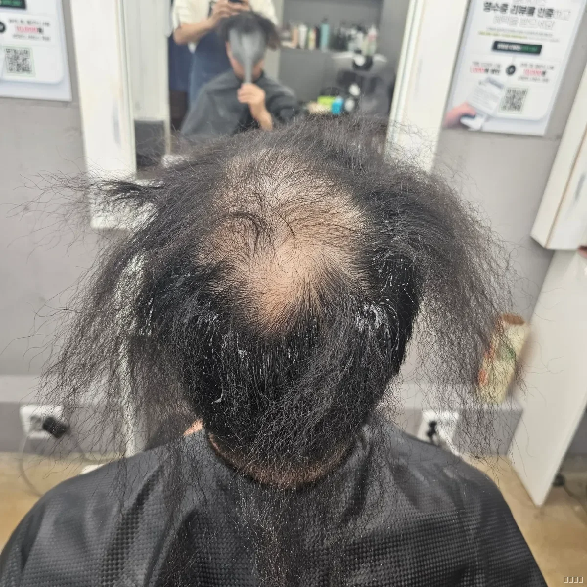 탈모 치트펌 파마 시술 전 사진 5