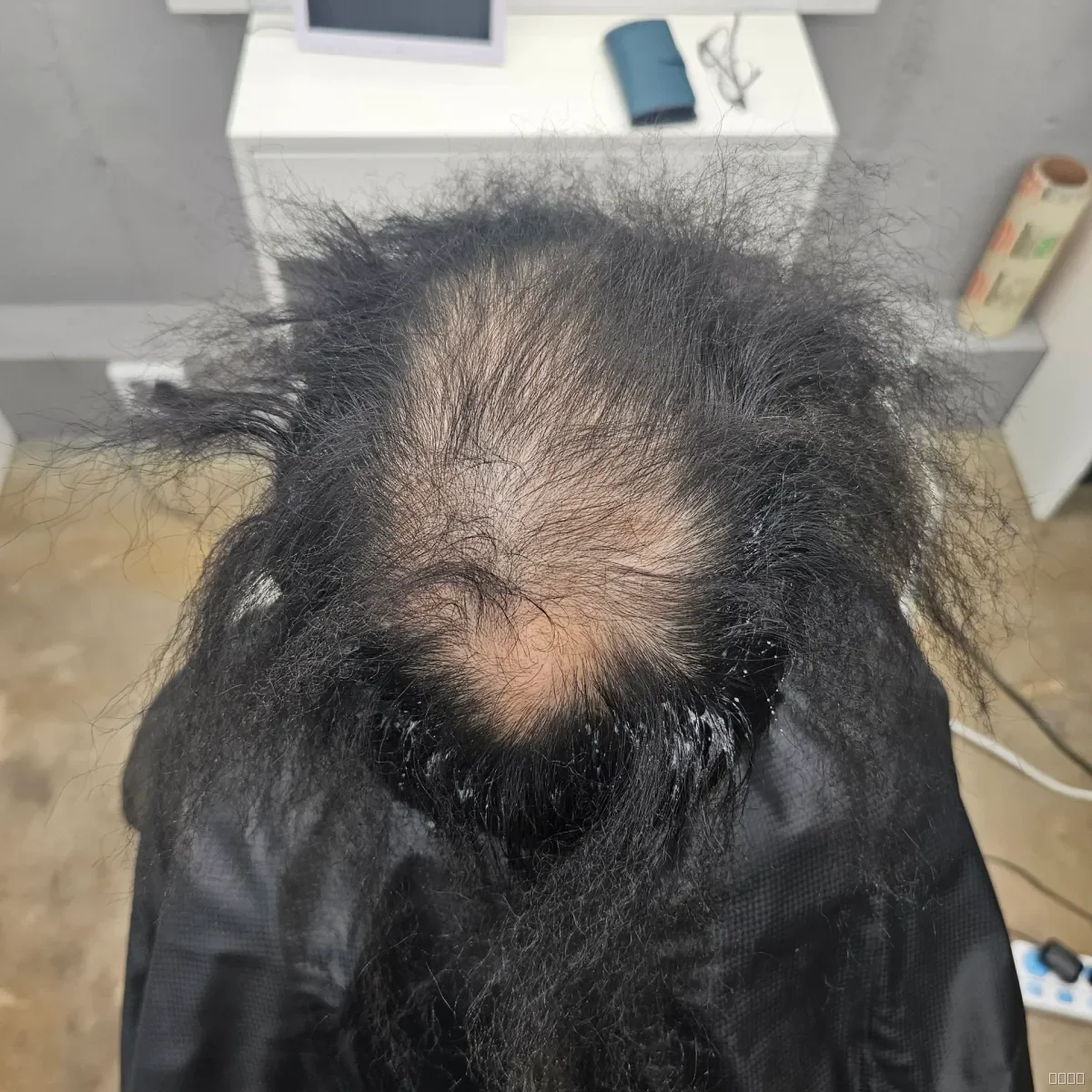 탈모 치트펌 파마 시술 전 사진 6