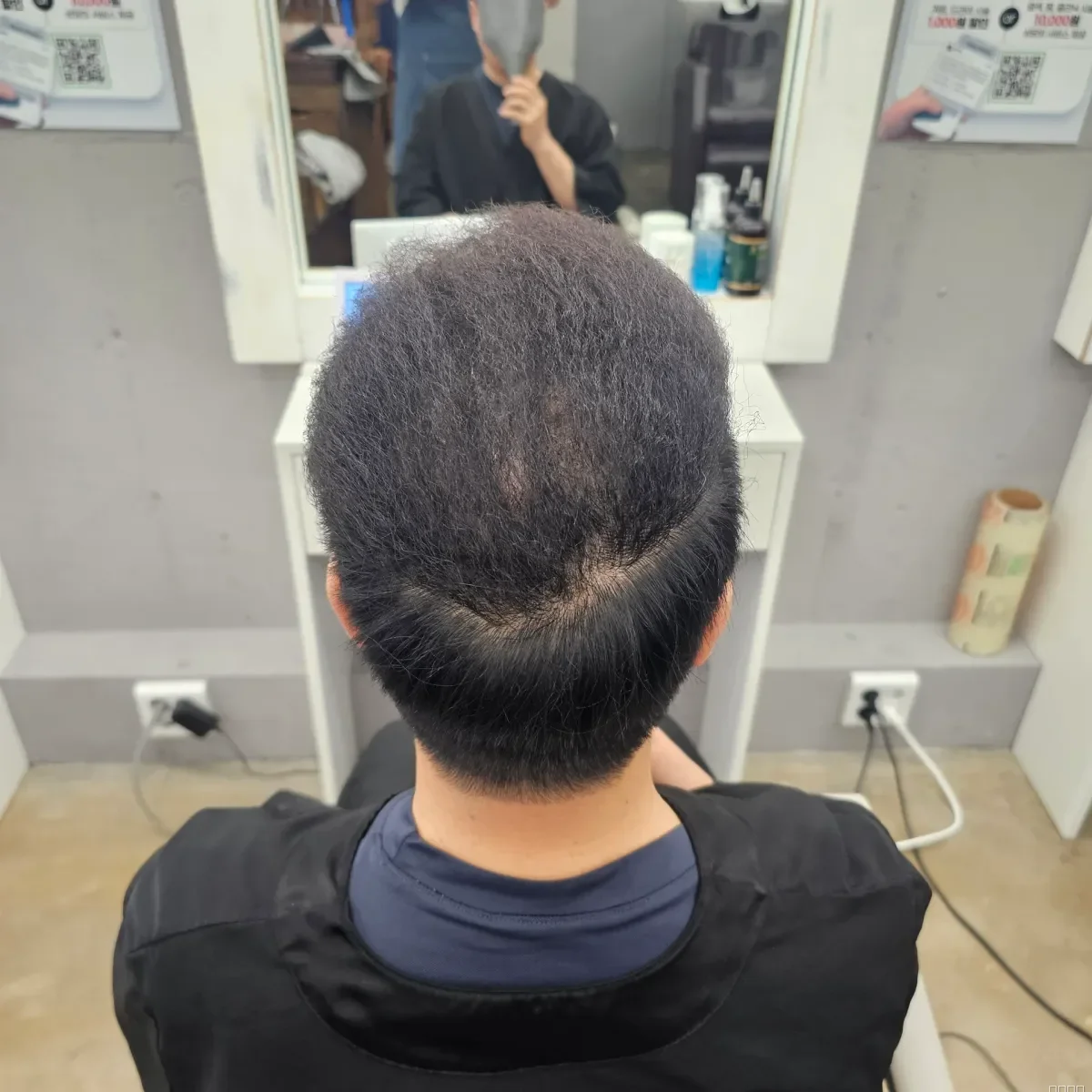 탈모 치트펌 파마 시술 후 결과 사진 5