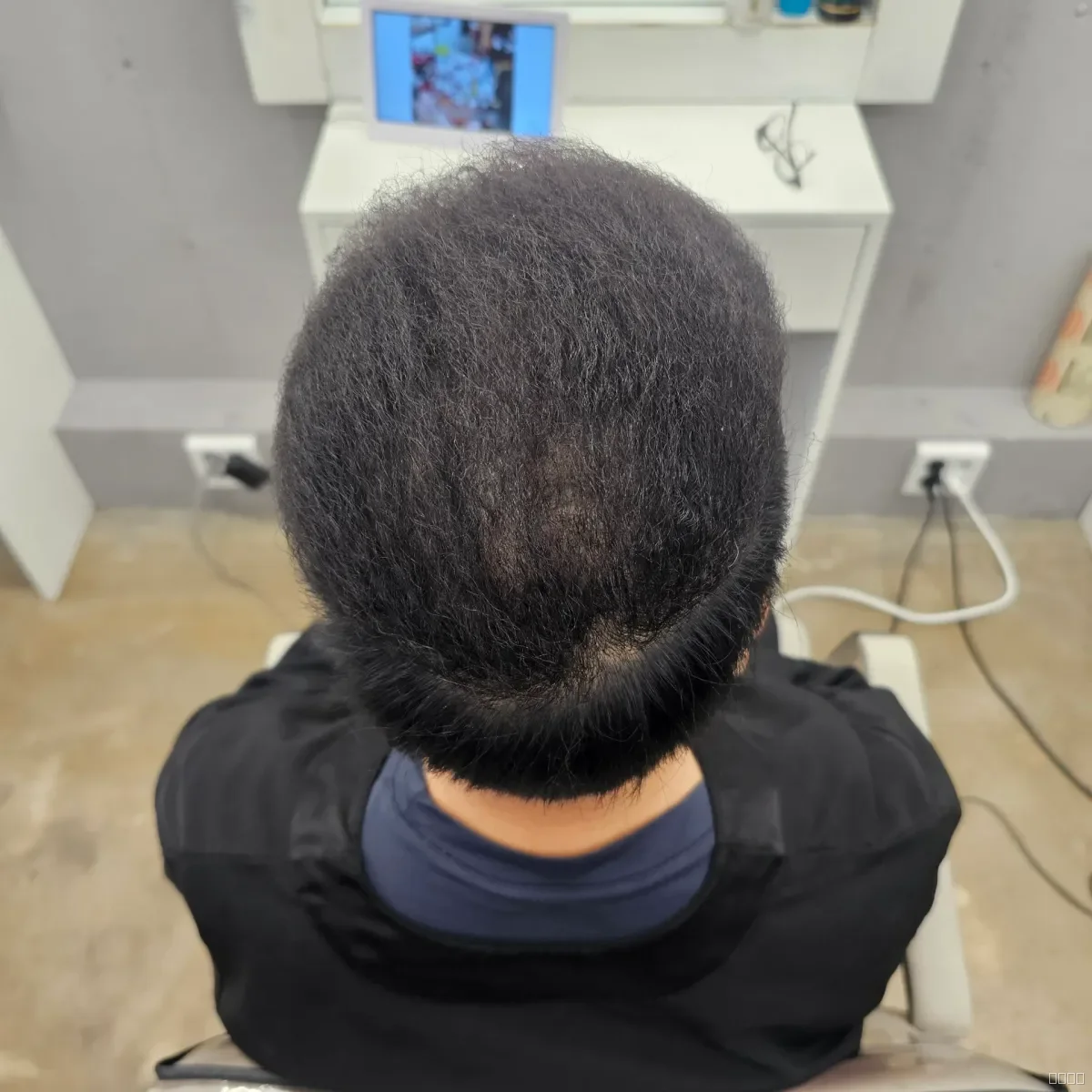 탈모 치트펌 파마 시술 후 결과 사진 6