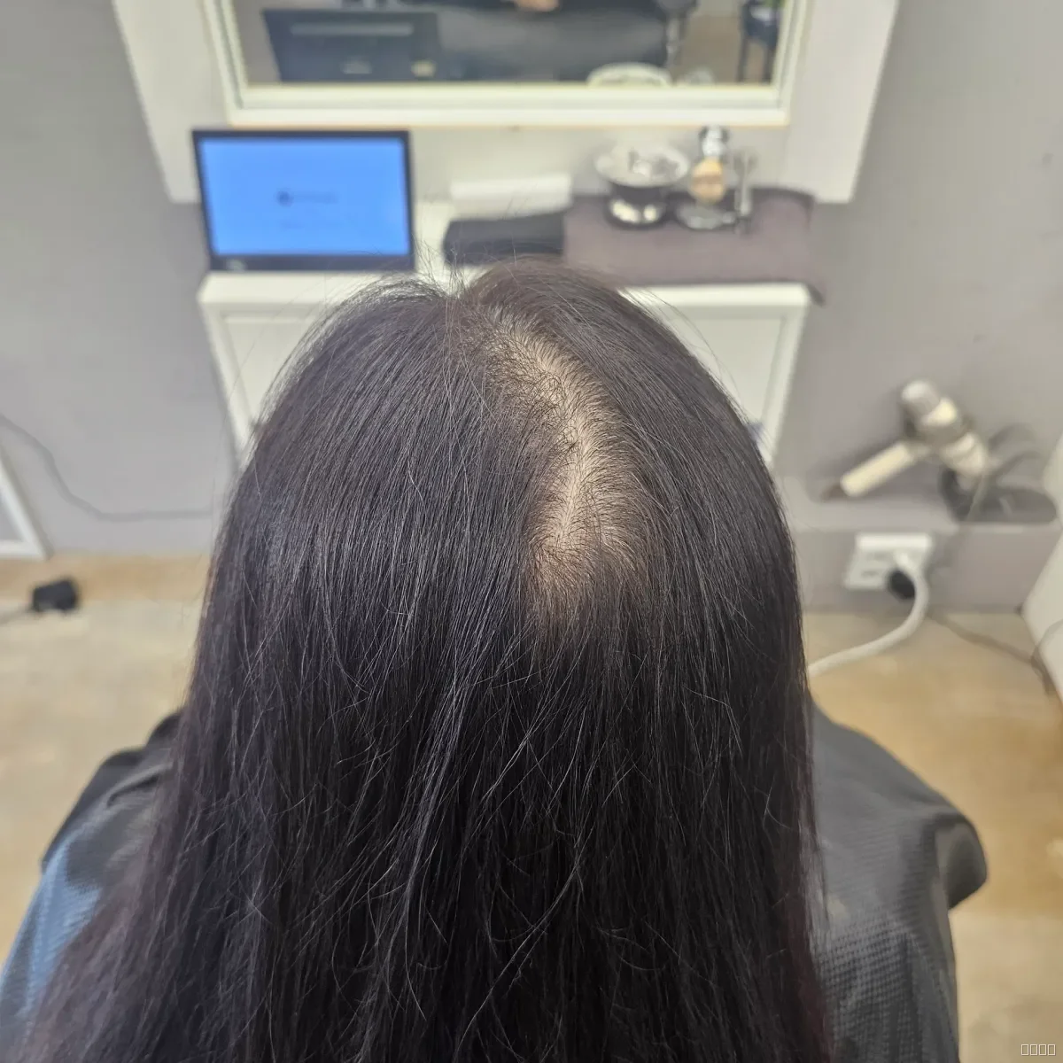 회춘펌 (뿌리볼륨 교정펌) 시술 전 사진 5