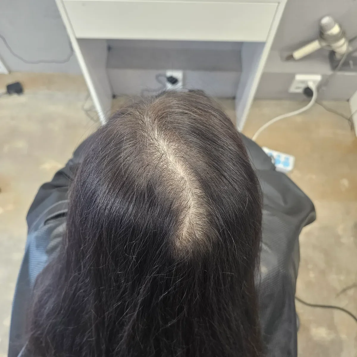 회춘펌 (뿌리볼륨 교정펌) 시술 전 사진 6