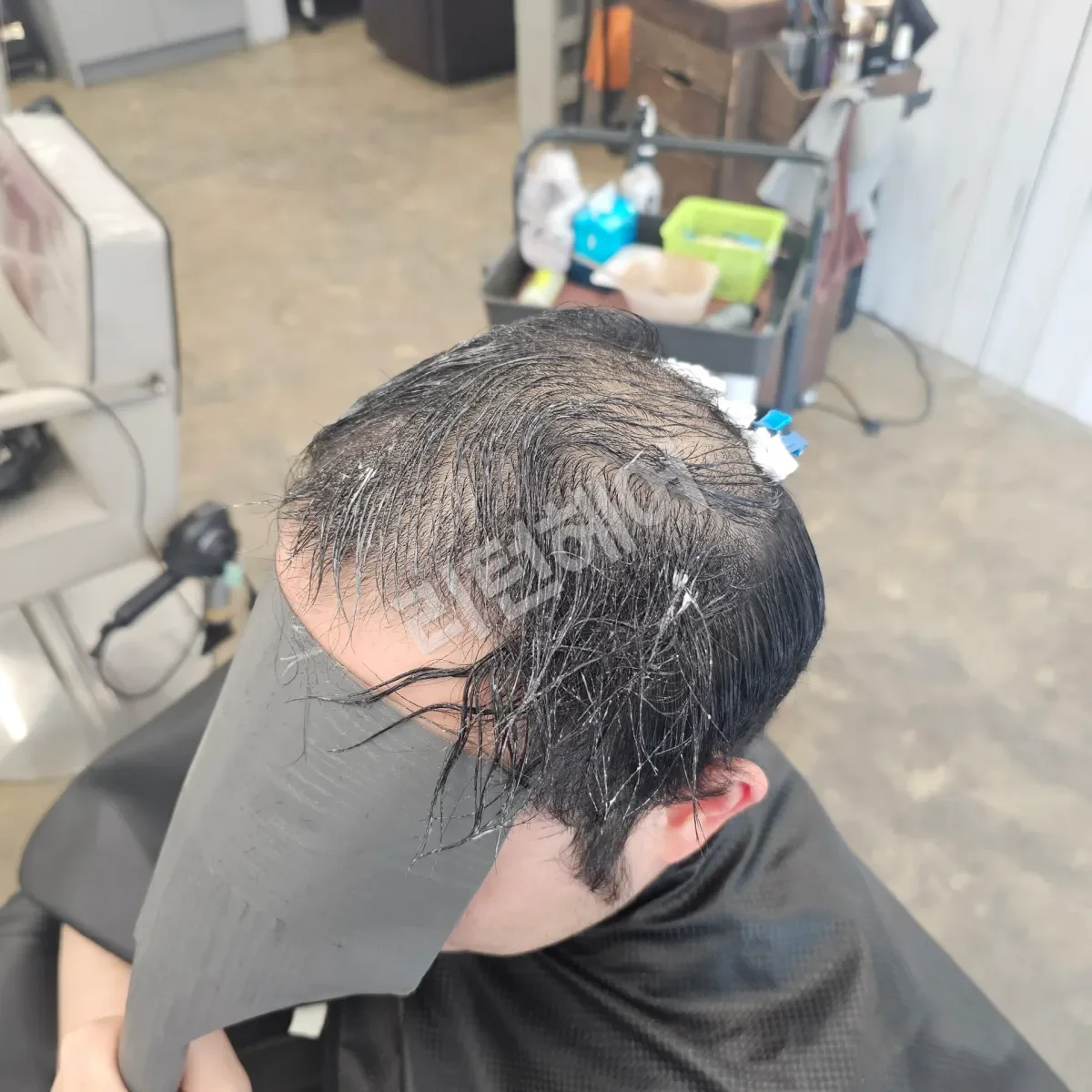 입춘 테라피 (플라즈마 PDRN) 시술 전 사진