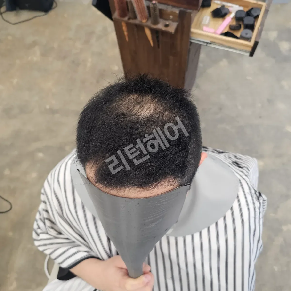 입춘 테라피 (플라즈마 PDRN) 시술 전 사진 2