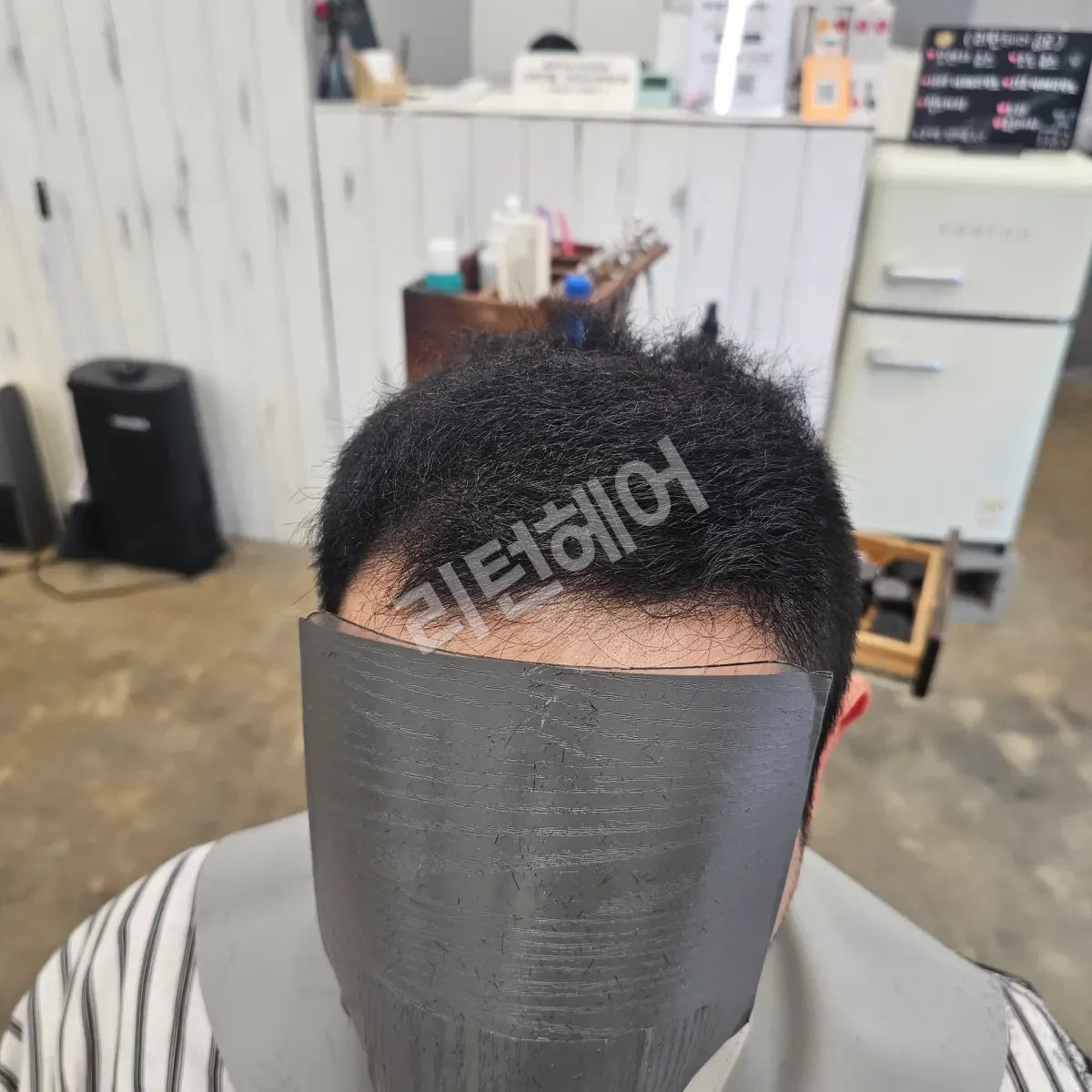 입춘 테라피 (플라즈마 PDRN) 시술 후 결과 사진