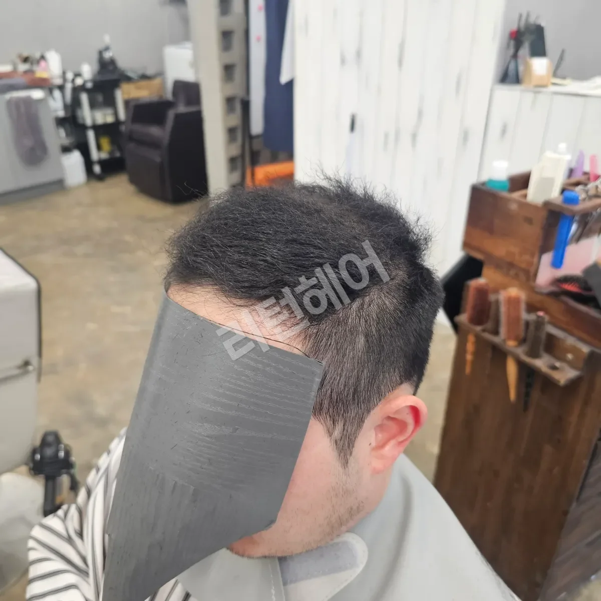 입춘 테라피 (플라즈마 PDRN) 시술 후 결과 사진 2