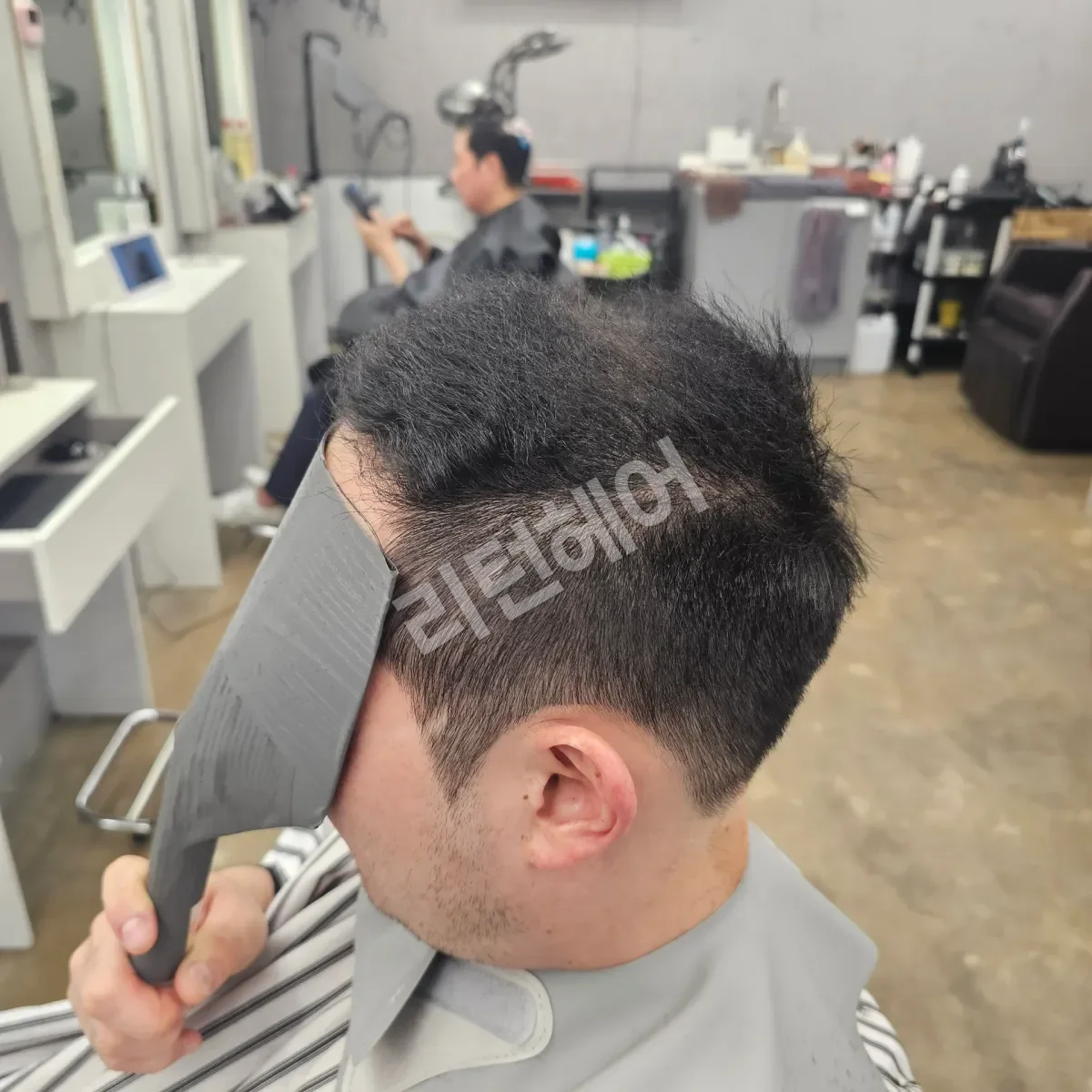 입춘 테라피 (플라즈마 PDRN) 시술 후 결과 사진 3