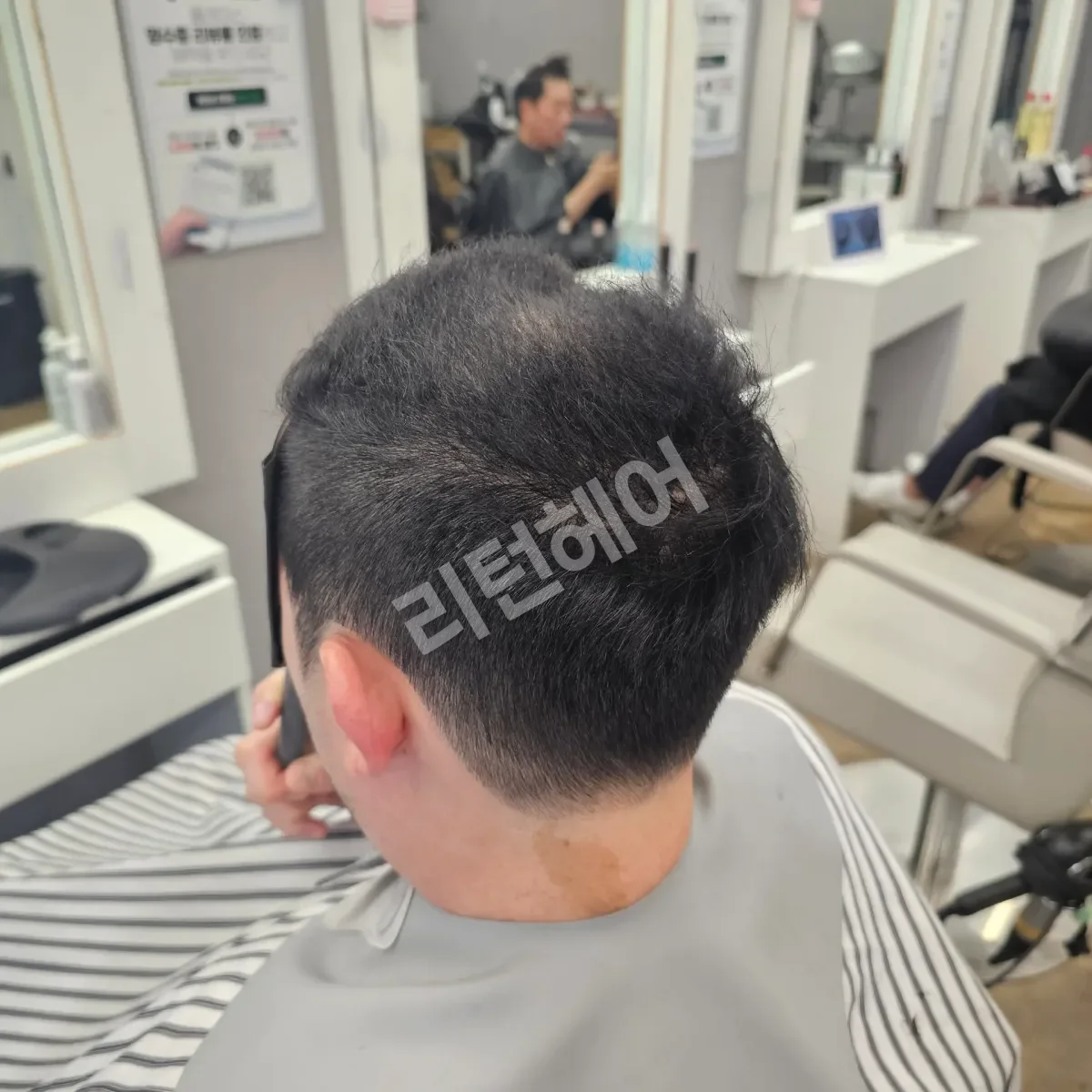 입춘 테라피 (플라즈마 PDRN) 시술 후 결과 사진 4